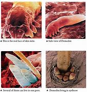 Image result for Face Mites Treatment