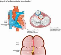 Image result for AV Canal Defect Down Syndrome