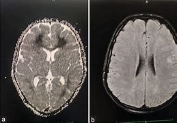 Image result for Toxic Leukoencephalopathy