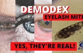 Image result for Eyelash Mites Symptoms