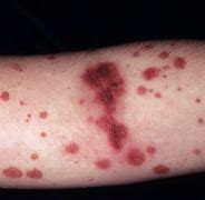 Image result for Vasculitis Signs