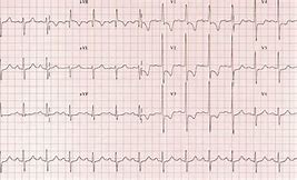 Image result for Right Ventricular Hypertrophy Echo