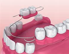 Image result for Partial Plate Dentures