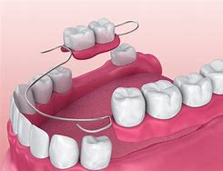 Image result for Upper Partial Dentures Pictures