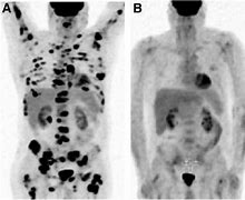 Image result for Pet Scan Lymphoma Example