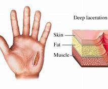 Image result for Skin Laceration Down to the Dermis