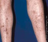 Image result for Dark Age Spots On Legs