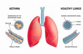 Image result for Lungs of a Person with Asthma