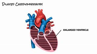 Image result for Dilated Cardiomyopathy EKG