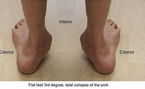 Image result for Arch Collaps Feet