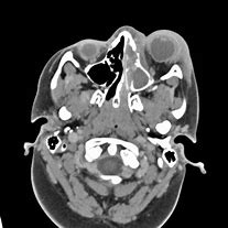 Image result for Subperiosteal Abscess Orbital Cellulitis