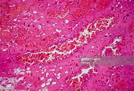 Image result for Hemangioma Tumor