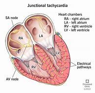 Image result for Permanent Junction Al Reciprocating Tachycardia