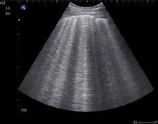 Image result for Lung Ultrasound B Lines Pulmonary Edema