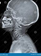 Image result for Thumb X-ray Child