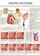 Image result for Angina Pectoris Anatomical Position