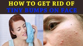 Image result for How to Get Rid Acne Bumps