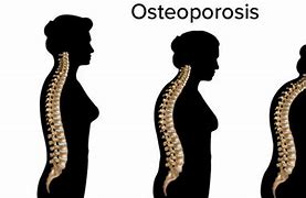 Image result for Osteoporosis Lumbar Spine