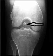 Image result for Posterior Knee Loose Bodies