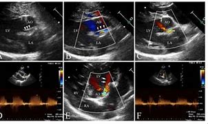 Image result for Right Parasternal View Echo