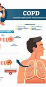 Image result for COPD Pinterest