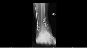 Image result for Trimalleolar Ankle Fracture 4 Plates