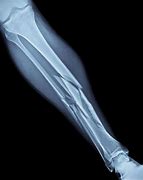 Image result for A Broken Bone