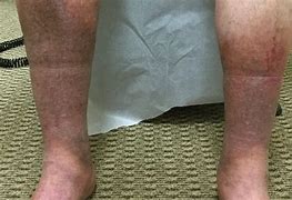 Image result for Dark Age Spots On Legs