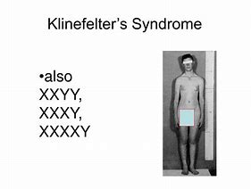 Image result for Klinefelter's Syndrome