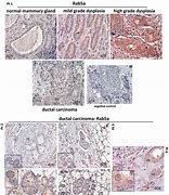 Image result for DDR and Bone Metastasis