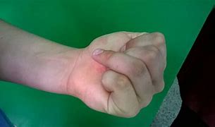 Image result for Jersey Finger X-ray