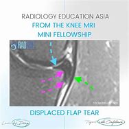 Image result for Flap Tear Meniscus