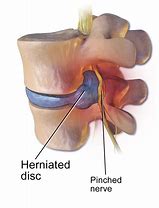 Image result for Lumbar Spine Herniation