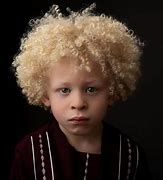 Image result for Child Boy Albino