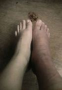 Image result for Cyanosis Legs