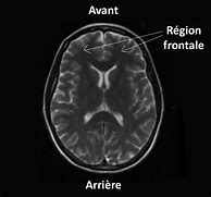 Image result for IRM Cerebrale