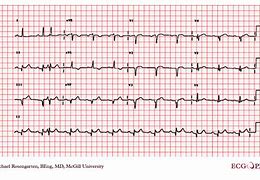 Image result for Premature Atrial Contraction