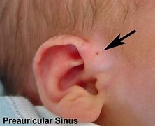 Image result for Pricualar Sinus Ear