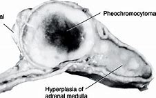 Image result for Medulla Tumor