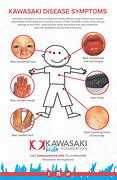 Image result for Kawasaki Virus Symptoms