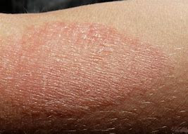 Image result for Groin Eczema Treatment