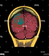 Image result for Thrombose Veineuse Musculaire IRM