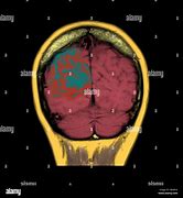 Image result for Thrombose Veineuse Musculaire IRM