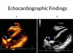 Image result for Interatrial Septum Lipomatous Hypertrophy Echo