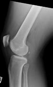 Image result for Normal Lateral Knee Radiograph