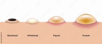 Image result for Pustule Skin Lesion