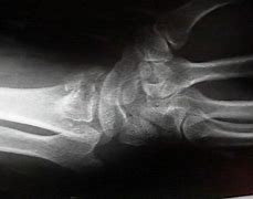 Image result for Volar Fracture