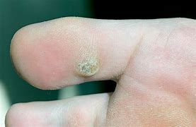 Image result for Plane Warts