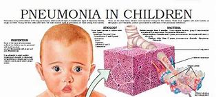 Image result for Childhood Pneumonia