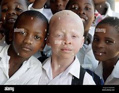 Image result for South African Albino